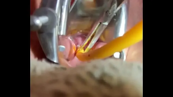 XXX Inserting Foley into cervix نئے ویڈیوز